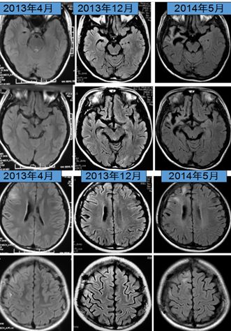 Rasmussen脑炎、结核性肉芽肿、脑发育性静脉畸形丨3分钟读片·第13期,下)
