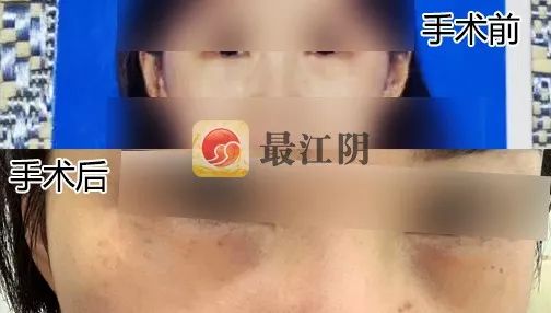 江阴去泪沟,女子花326万整容后续