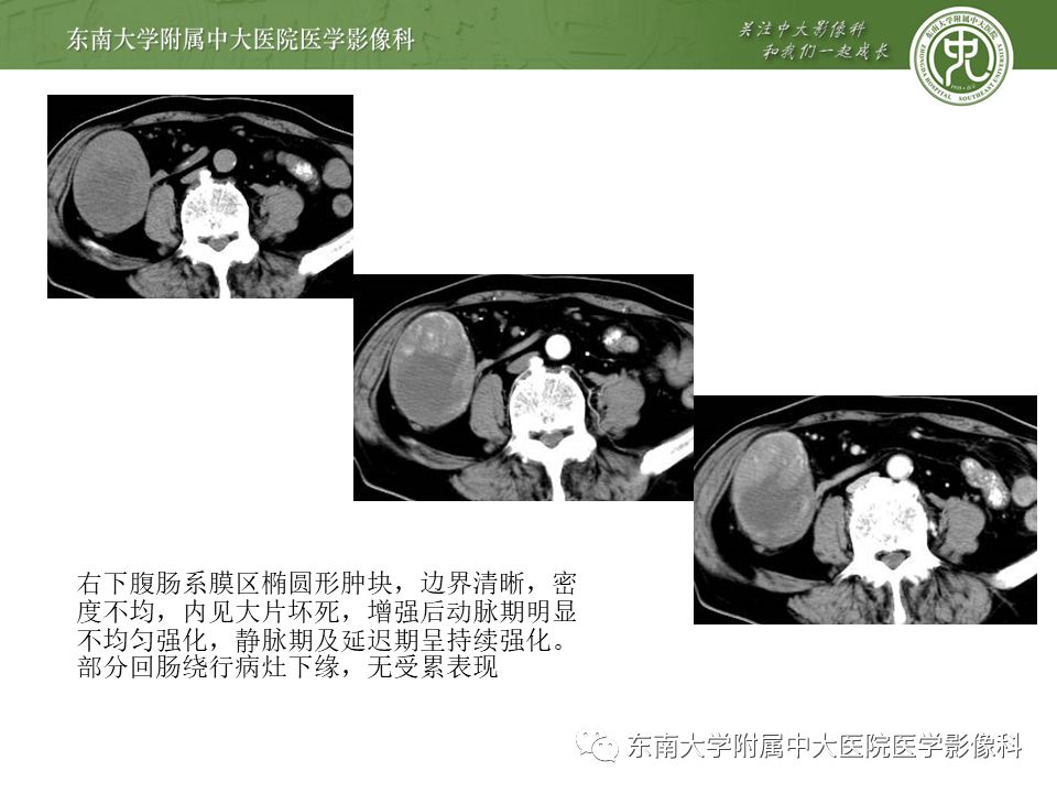 侵袭性纤维瘤影像学表现,侵袭性纤维瘤病影像上易诊断吗