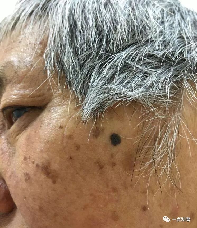 老年人皮肤癌是怎么得的,老人脸上长肉粒是皮肤癌吗