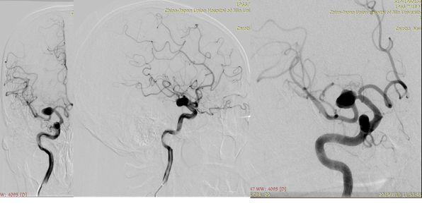治疗颅内动脉瘤新型密网支架,pipeline治疗椎动脉夹层动脉瘤