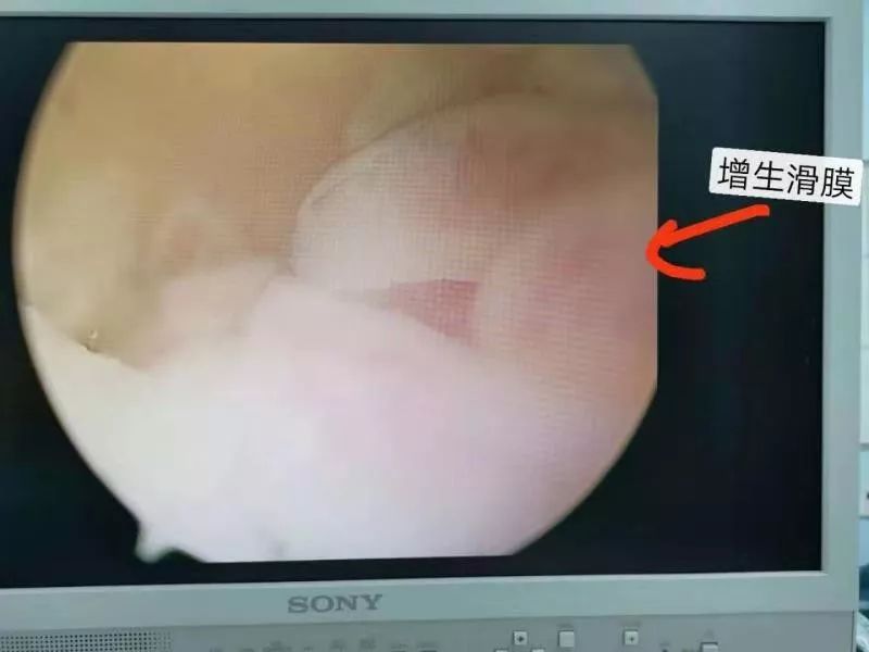 50岁女子手肘关节突然疼得动不了，医生手术取出一团“海绵”...