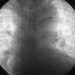 冠脉造影技术成熟不,跟我学技术分析从入门到精通