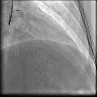 冠脉造影技术成熟不,跟我学技术分析从入门到精通