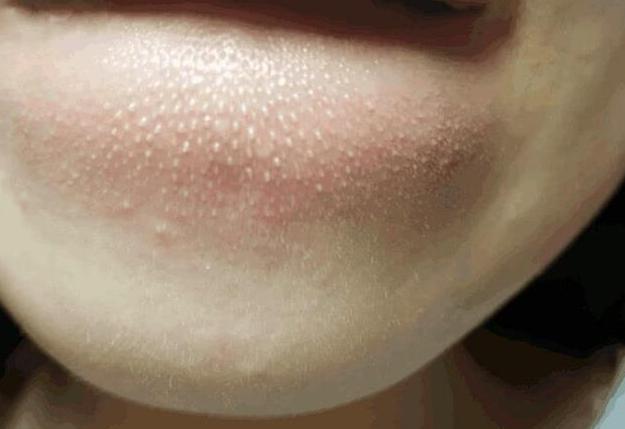 下巴螨虫白色小颗粒,下巴上有白皮屑