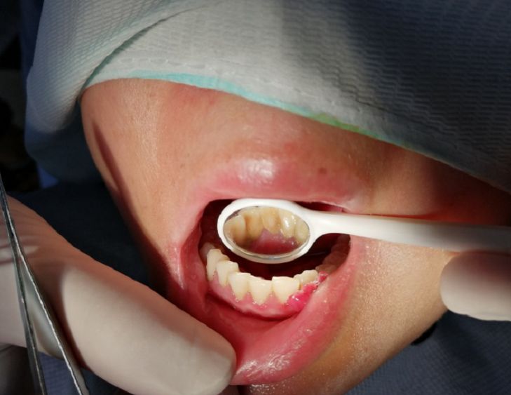 孕27周牙龈肿痛怎么办,准妈妈孕晚期出现牙龈瘤