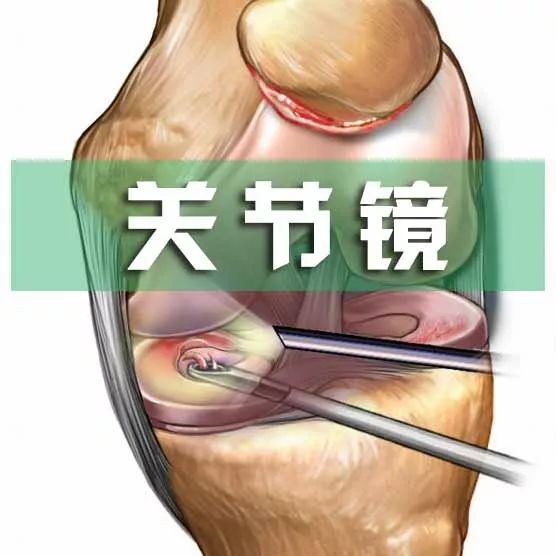 摔了一跤半月板二度撕裂,摔一跤膝盖半月板裂开了