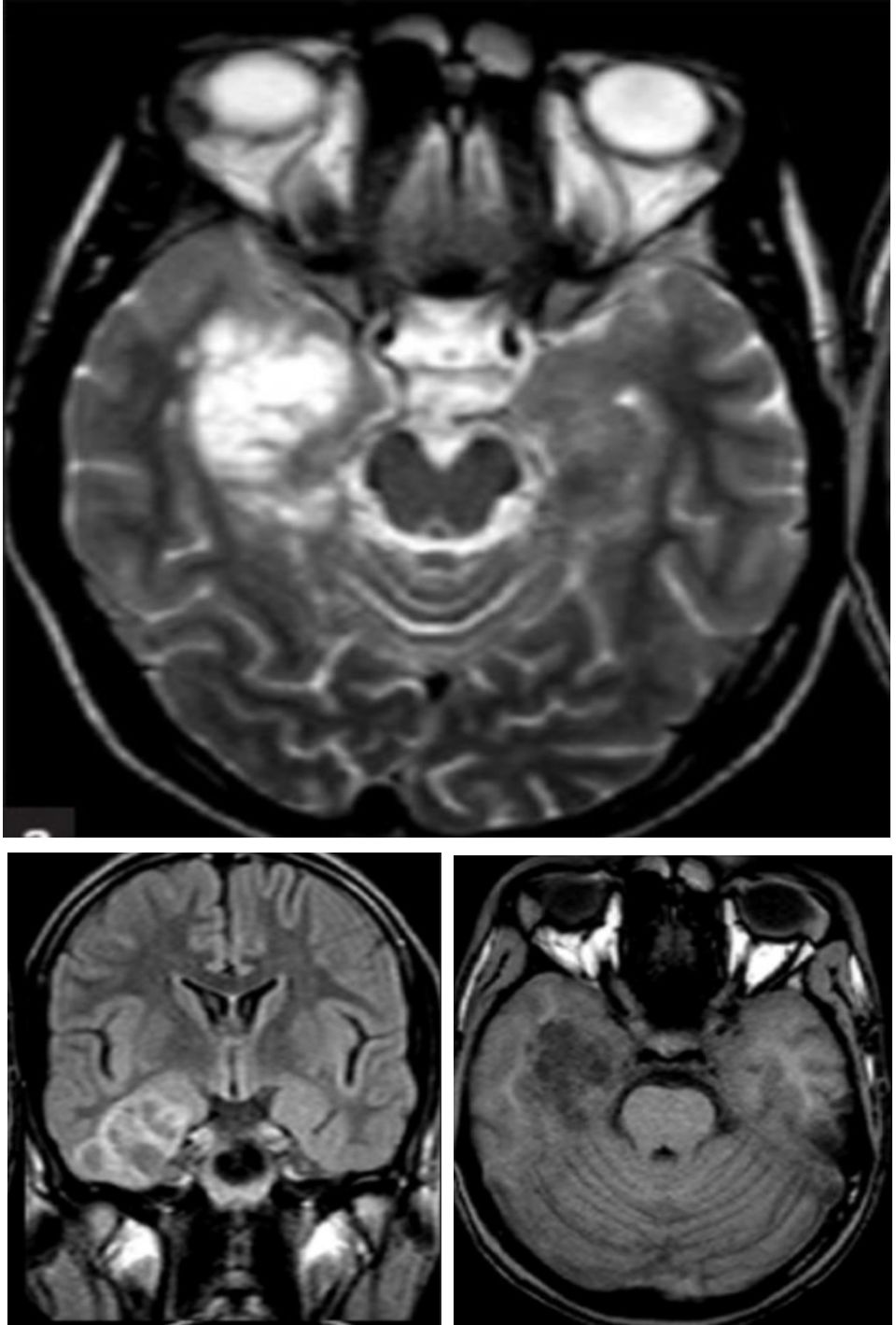 Whipple病、纹状体手、神经结节病、脱髓鞘假瘤丨3分钟读片·第16期