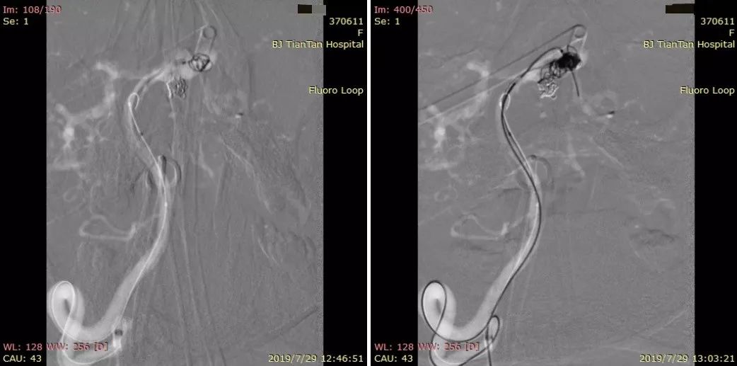 物华天宝·第12期｜复发多发动脉瘤合并烟雾病的支架辅助弹簧圈栓塞治疗