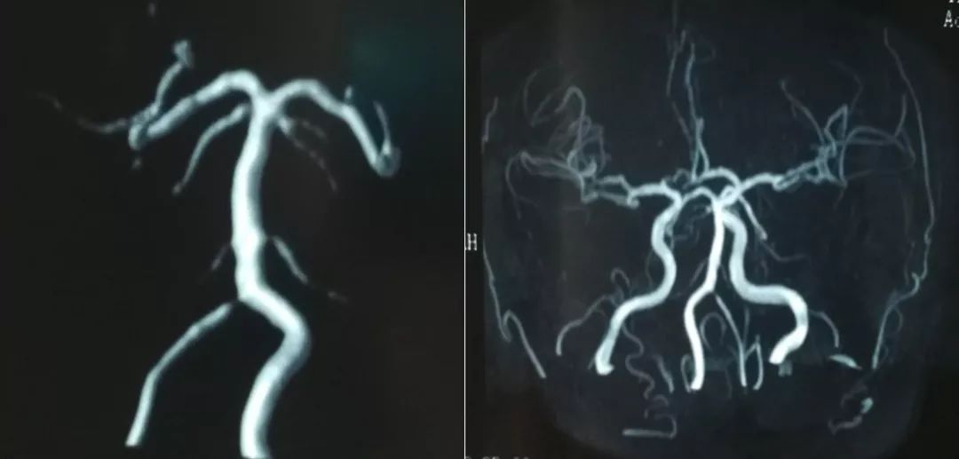 中医治疗脑夹层动脉瘤,3d演示夹层动脉瘤支架治疗