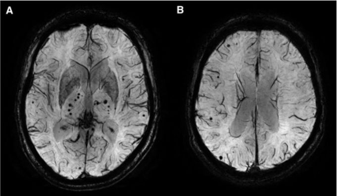 自发性脑出血成功案例分享,一文读懂近期脑出血研究