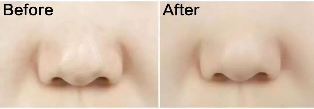 草莓鼻去黑头好物推荐使用,草莓鼻去黑头导出液