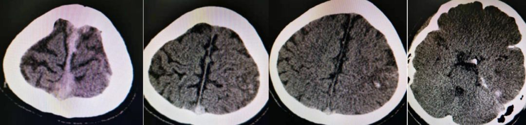 矛盾反应、Carney综合征、脑梗死、笑气中毒丨3分钟读片·第19期