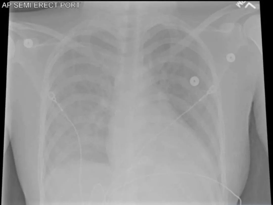 感染性心内膜炎的护理常规记录,新生儿感染性心内膜炎