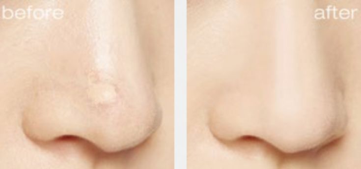 植村秀遮瑕笔测评,植村秀隔离遮瑕ysl