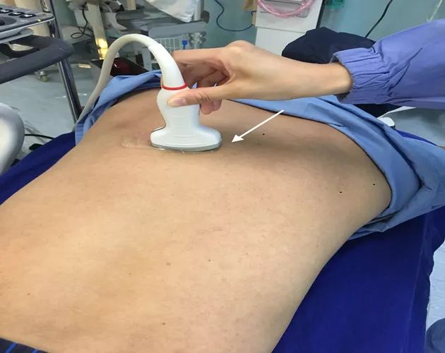 胸椎旁神经阻滞时需要穿过的韧带,胸椎旁神经阻滞超声探头位置