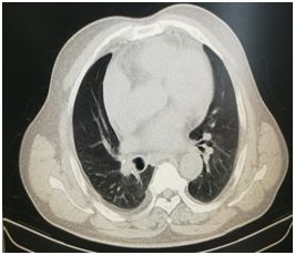 胸腔积液中医诊断是什么,胸外科微创治疗胸腔积液