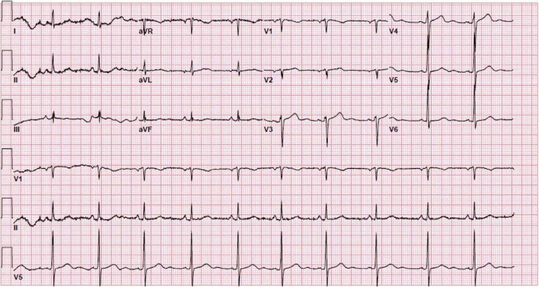 高血压急症的治疗,高血压急症个案