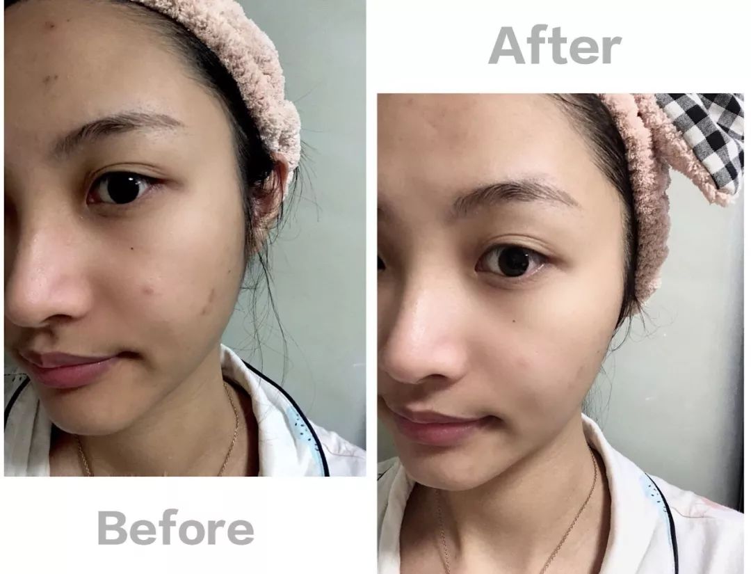 急救面膜意大利,意大利医用补水面膜