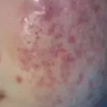 战痘总结,战痘十年是什么样子