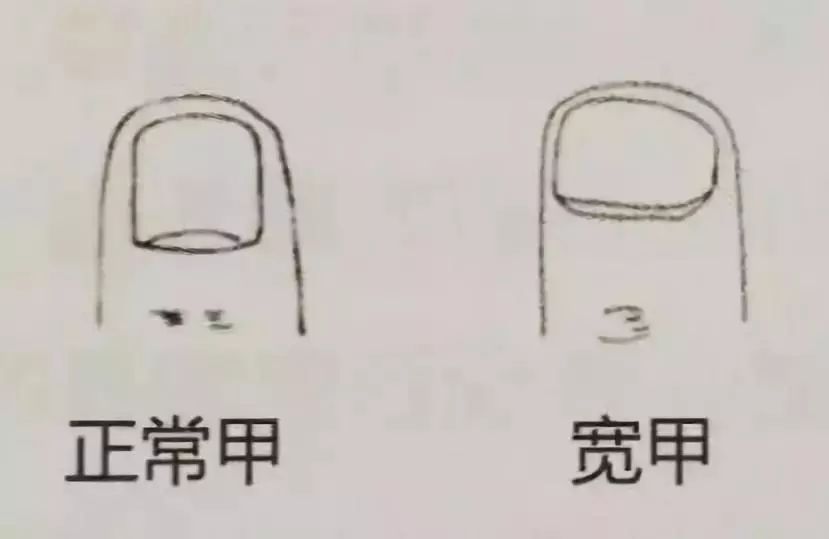 科普|指甲的状态反映了你身体的状况