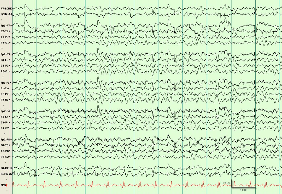 脑电图伪差图,脑电图伪差图谱