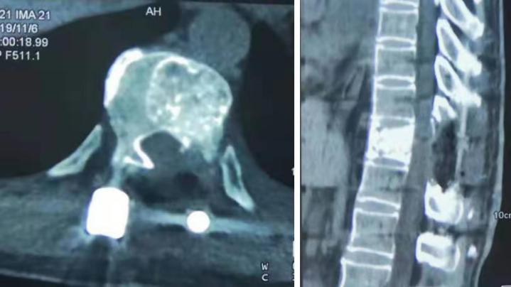 胸椎瘤手术,胸椎旁肿瘤手术成功率