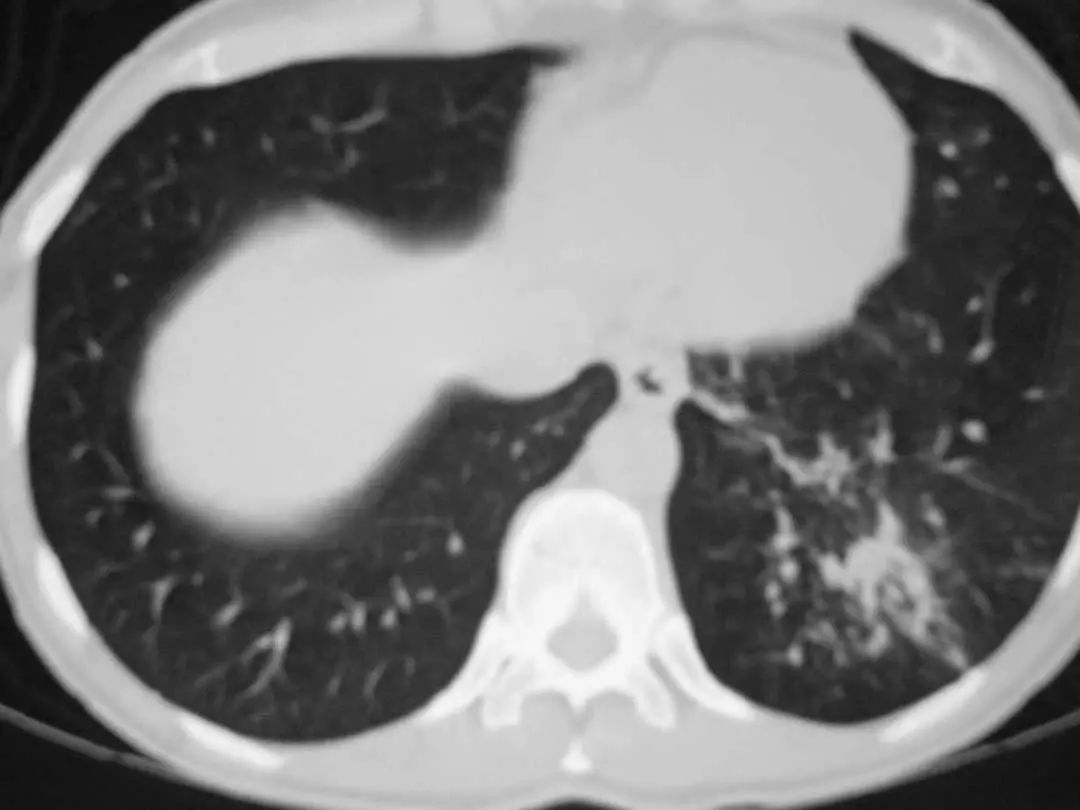 26张图，搞懂细菌性肺炎与病毒性肺炎