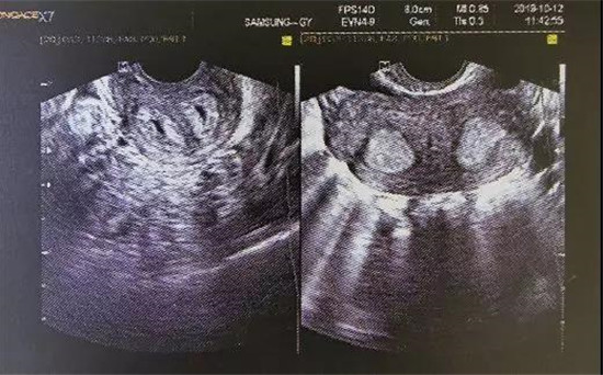 雅安恒博医院看妇科好不好,雅安恒博医院会摘除子宫吗