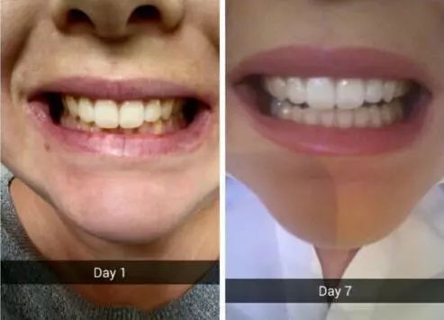 不用打磨牙齿的快速美白方法,不用洗牙能把牙垢黄牙变白的方法