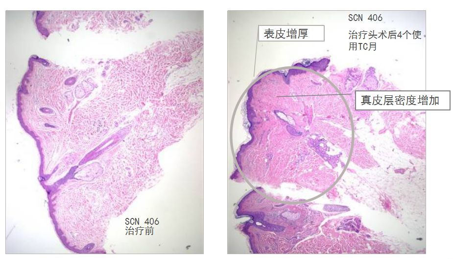 热玛吉抗衰老手术适应6类人群,了解热玛吉抗衰老看这篇就够了