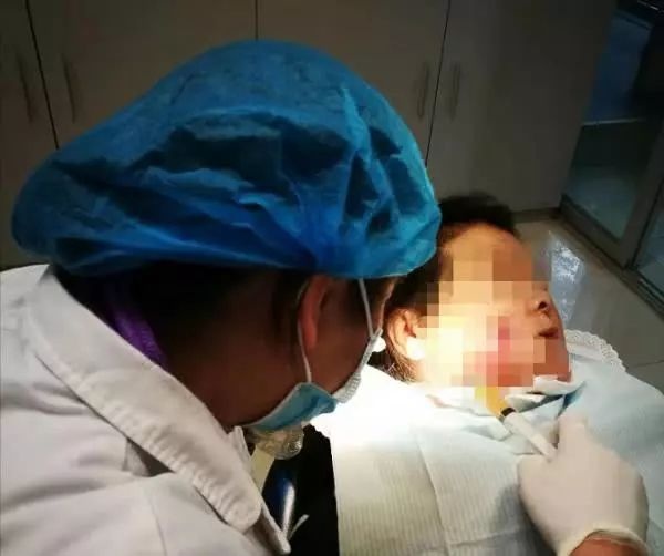 一女子长期吃烫的得了口腔癌,女子嚼槟榔得口腔癌致死