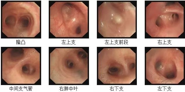 肺部感染鉴别诊断病例,双肺感染病例报告
