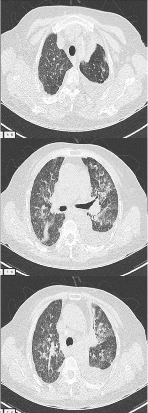 肺部感染鉴别诊断病例,双肺感染病例报告