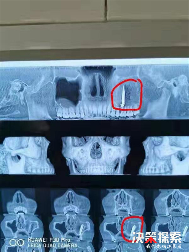 心焦！南阳一小伙因牙疼难忍，竟将铁钉牙签棍儿等插入牙床“钉灸”……