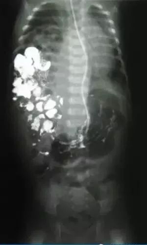 临床思考：新生儿呼吸窘迫的原因是什么？