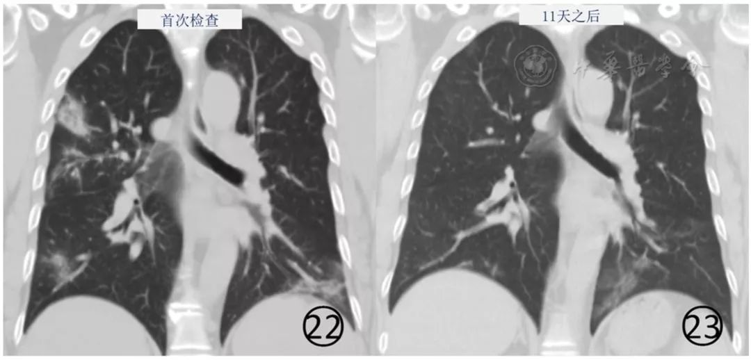 新冠肺炎影像演变过程,新冠肺炎胸部影像学特点有哪些