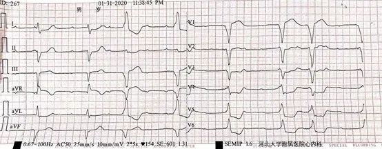 病例丨“一波三折”的三度房室传导阻滞，原因何在？