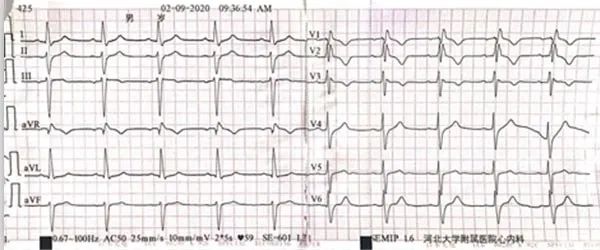病例丨“一波三折”的三度房室传导阻滞，原因何在？