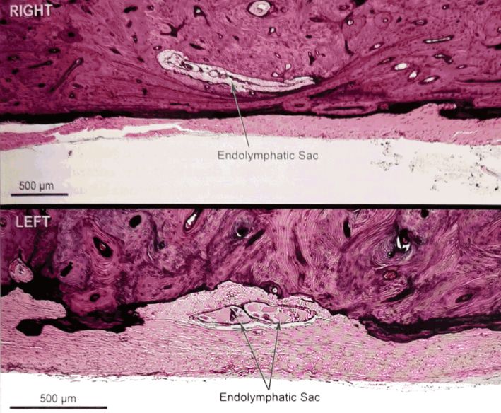 梅尼埃病深度解析,梅尼埃病病理解剖