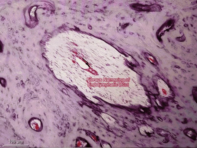 梅尼埃病深度解析,梅尼埃病病理解剖
