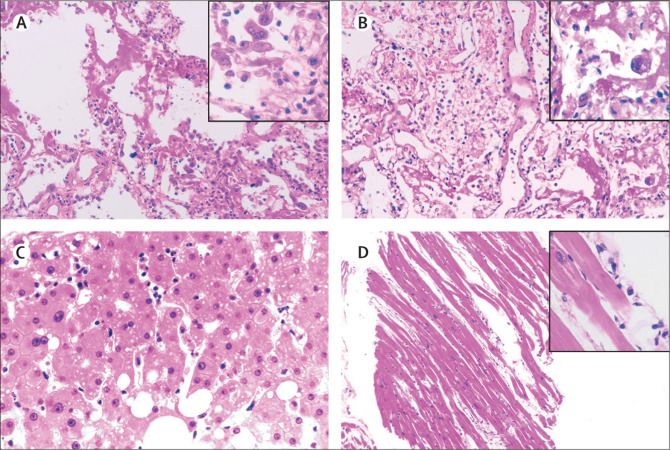 新冠气道炎症分泌物多,新冠肺炎呼吸道分泌物的处理