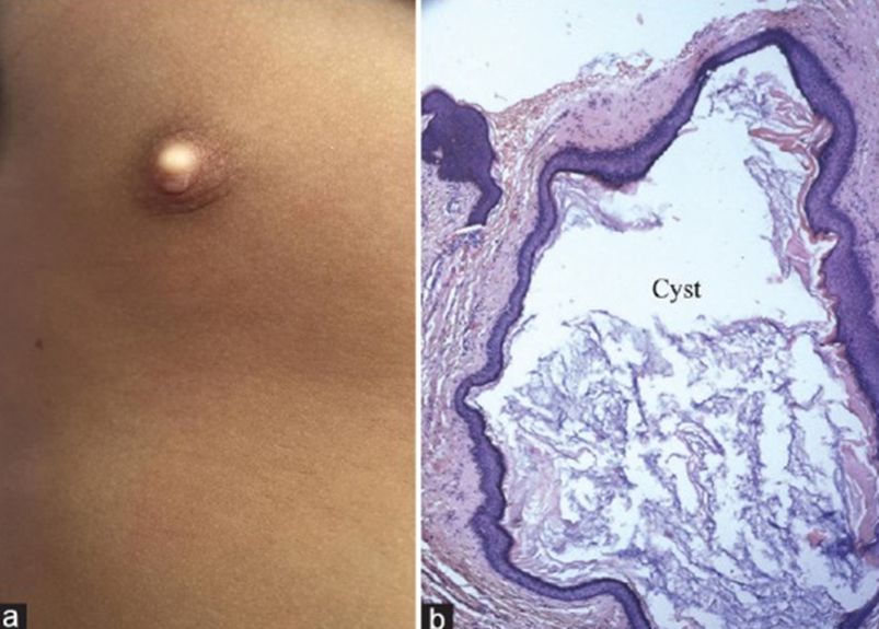 六个月宝宝粟丘疹,婴儿长粟丘疹是因为母乳吗