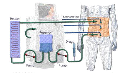 癌性腹水的治疗,治疗癌性腹水的最佳方法
