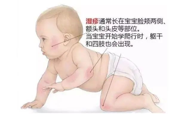 宝宝护理湿疹,宝宝湿疹护理视频教程育婴员