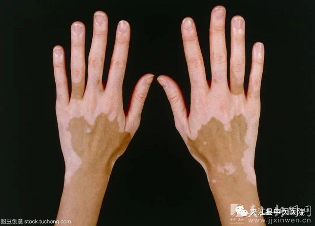 白癜风银屑病精准诊疗公益活动,白癜风公益活动