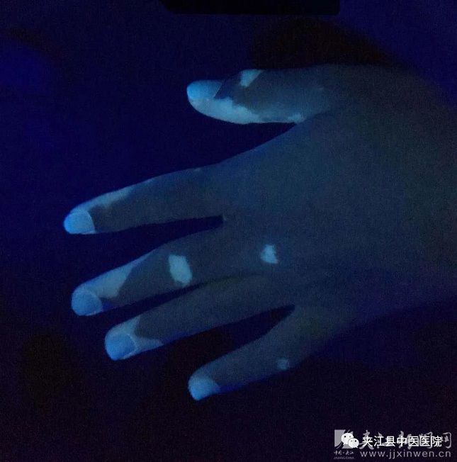 白癜风银屑病精准诊疗公益活动,白癜风公益活动