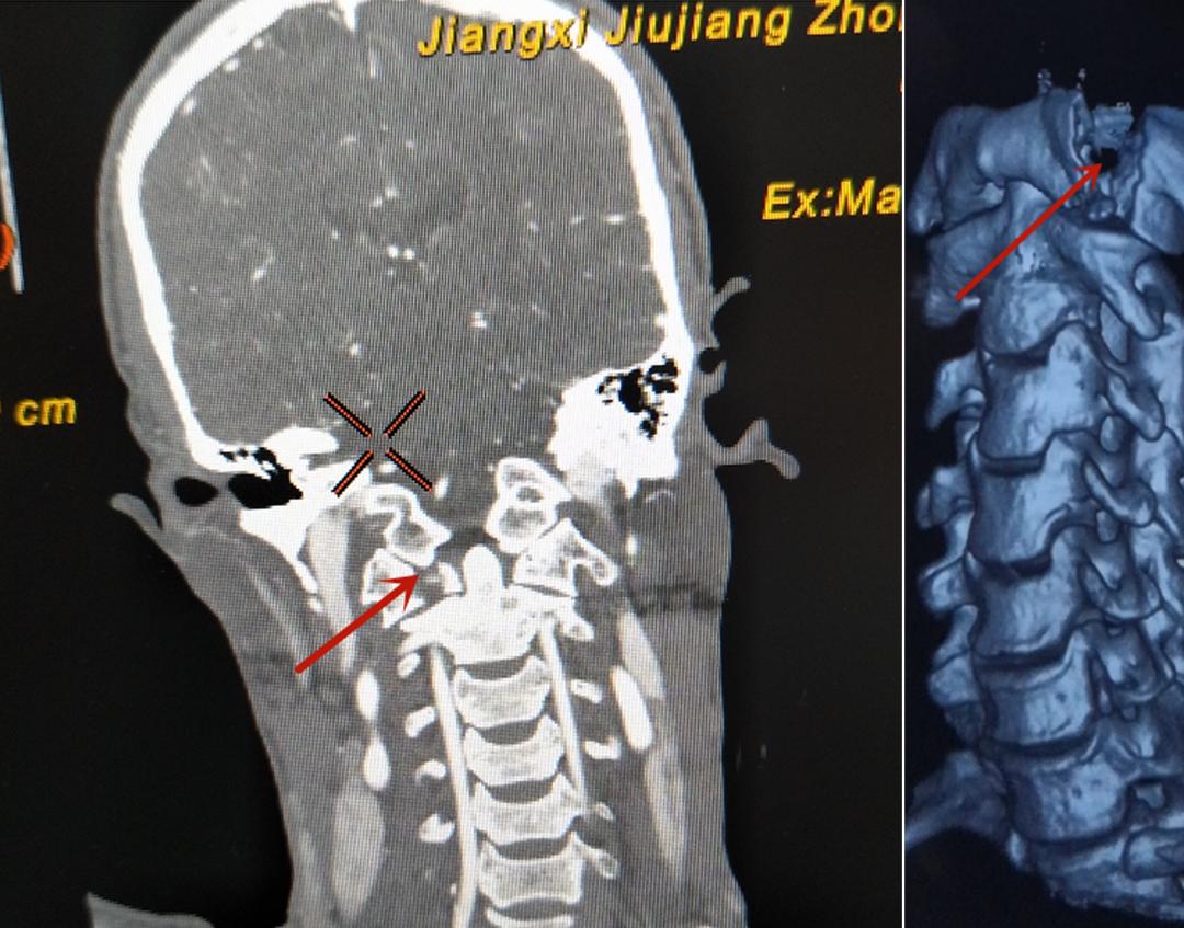 中医院脑病科介入手术,市中医院脑病科