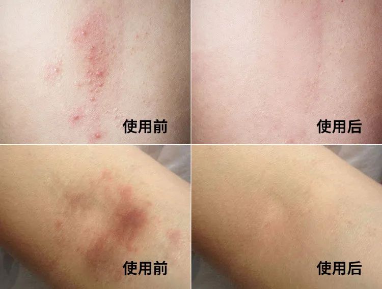 长小水泡很痒用什么中药,皮肤止痒起包用哪个药膏