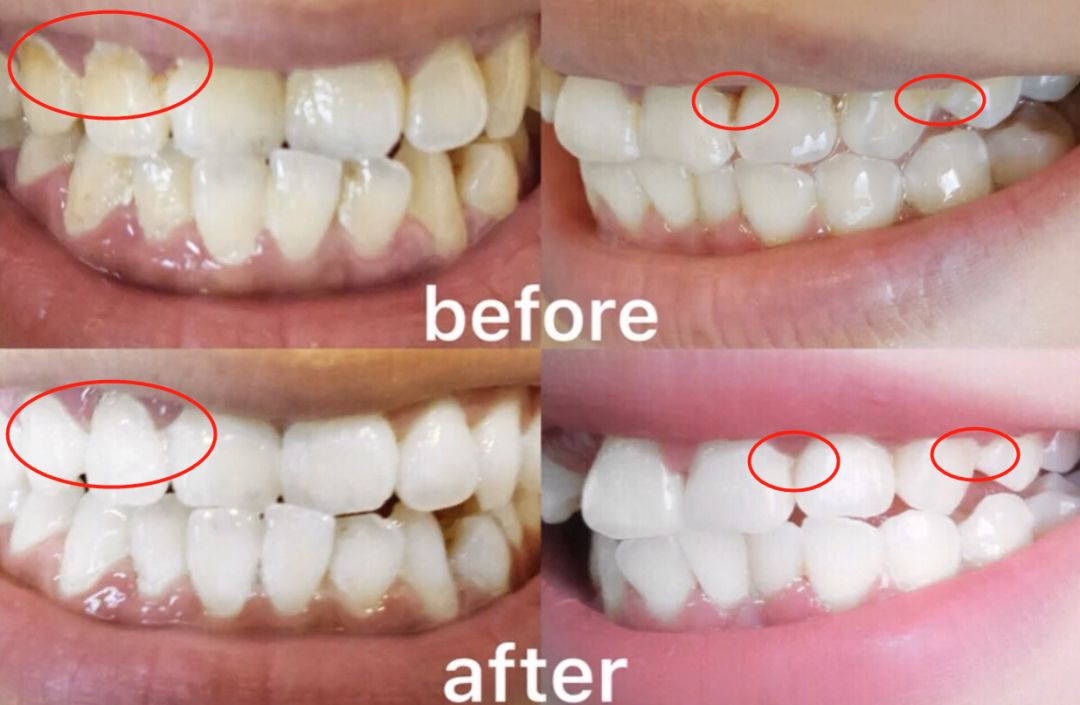 牙龈上火、红肿，还口臭？香港人用了91年的中药牙膏，消炎抑菌，让你刷出一口健康好牙